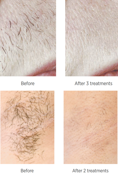 Laser Hair Removal Aftercare Dos Donts When to Seek Help
